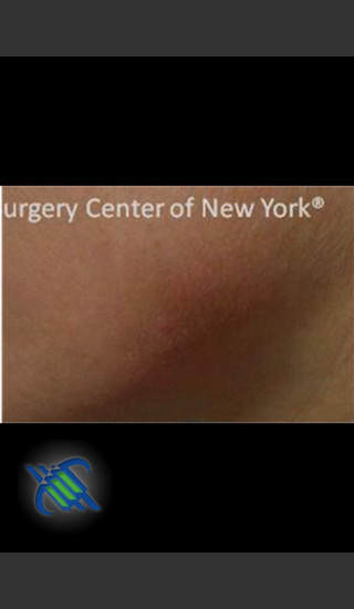 After Photo for Treatment of Bruising - Roy G. Geronemus, M.D. - Prejuvenation