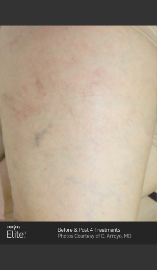 After Photo for Leg Vein Clearance Using Elite -  - Prejuvenation
