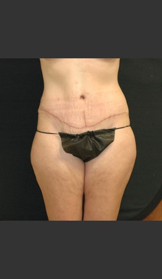 After Photo for Tummy Tuck Case #1 - Gallaher Plastic Surgery & Spa MD - Prejuvenation