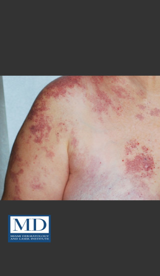 Before Photo for Port Wine Stain Treatment 104 - Jill S. Waibel, MD - Prejuvenation