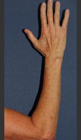 After Photo for Brown Spot Reduction on Arm - William F. Groff, M.D. - Prejuvenation