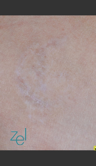 After Photo for Treatment of Symbol Tattoo - Brian D. Zelickson, M.D. - Prejuvenation