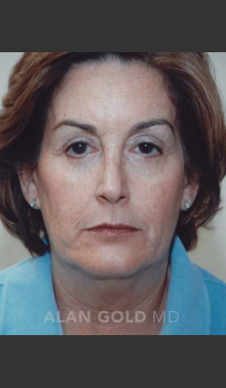 Before Photo for Rhytidectomy (Facelift) 120 - Alan Gold MD - Prejuvenation