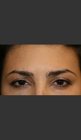 After Photo for Botox for Glabellar Lines - James Newman - Prejuvenation