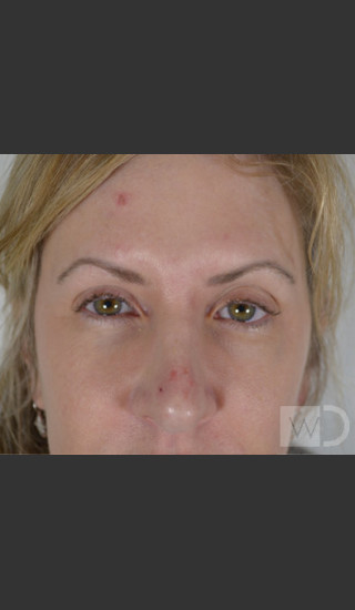 Before Photo for Upper Blepharoplasty - Chuma Chike-Obi MD - Prejuvenation