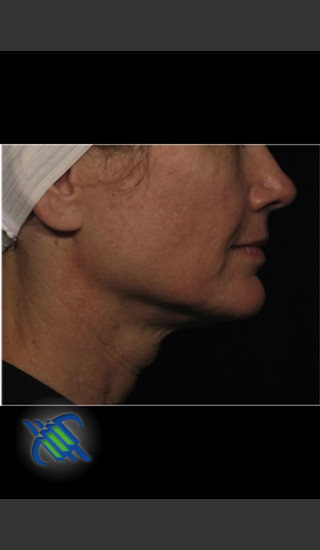 After Photo for Profound Treatment of Lower Facial Laxity - Roy G. Geronemus, M.D. - Prejuvenation
