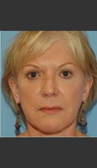 After Photo for Blepharoplasty - Timothy Miller - Prejuvenation