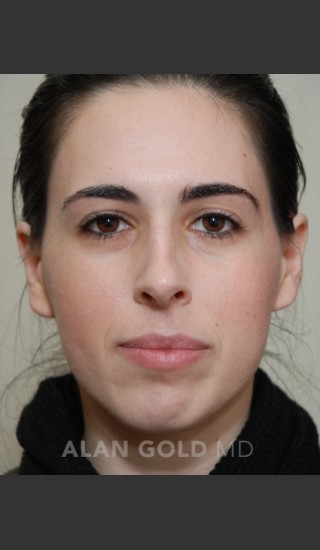 Before Photo for Rhinoplasty 1669 - Alan Gold MD - Prejuvenation