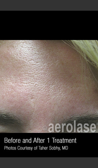 Before Photo for Treatment of Pores and Skin Texture #338 -  - Prejuvenation