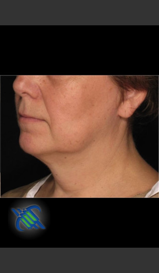 After Photo for Laser Liposuction of Lower Face - Roy G. Geronemus, M.D. - Prejuvenation