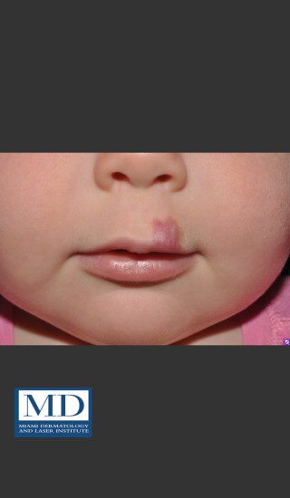 Before Photo for Hemangioma Treatment 107 - Jill S. Waibel, MD - Prejuvenation