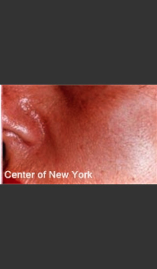 After Photo for Treatment of Facial Blood Vessels -  - Prejuvenation