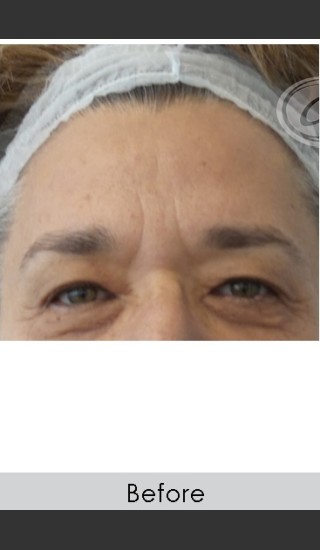 Before Photo for Dysport and Filler for Forehead Etched Lines - Annie Chiu, MD - Prejuvenation