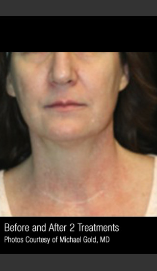 After Photo for Treatment of Pigmentation & Redness #332 -  - Prejuvenation