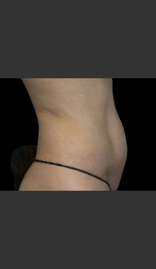Before Photo for Body Contouring Treatment #118 -  - Prejuvenation
