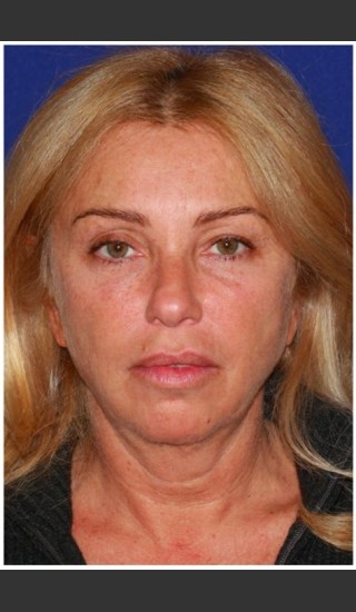 Before Photo for Facelift - Case 27 - Konstantin Vasyukevich, MD - Prejuvenation