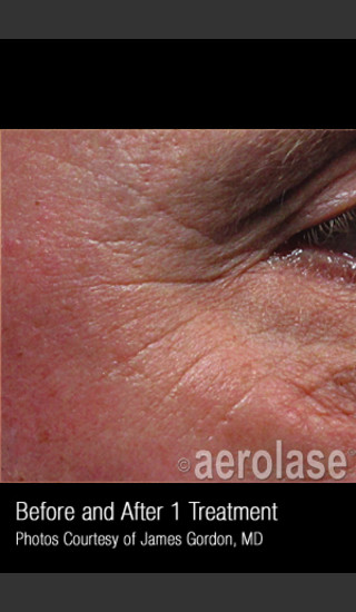 Before Photo for Treatment of Crows Feet #339 -  - Prejuvenation