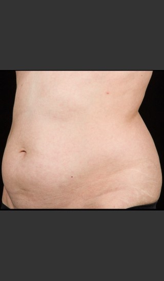 Before Photo for SculpSure Abdomen - Lawrence Bass MD - Prejuvenation