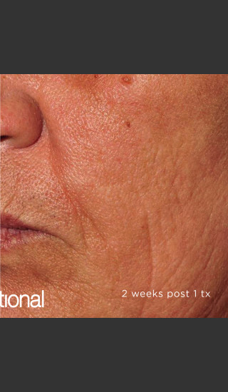 After Photo for Pearl Fractional Resurfacing of Wrinkles -  - Prejuvenation