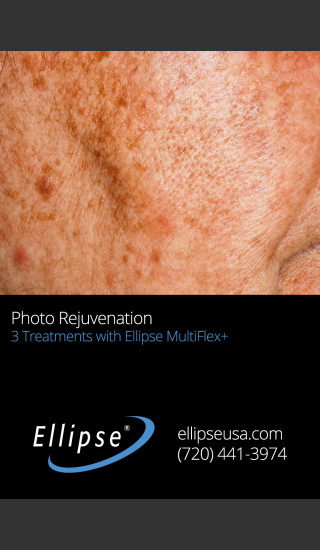 Before Photo for Full Face Rejuvenation after 3 Treatments  -  - Prejuvenation