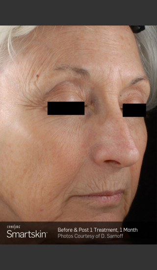 Before Photo for Wrinkle Reduction With SmartSkin Resurfacing -  - Prejuvenation