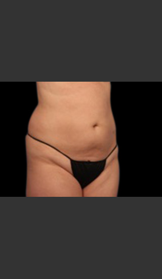 After Photo for Body Contouring Treatment #119 -  - Prejuvenation