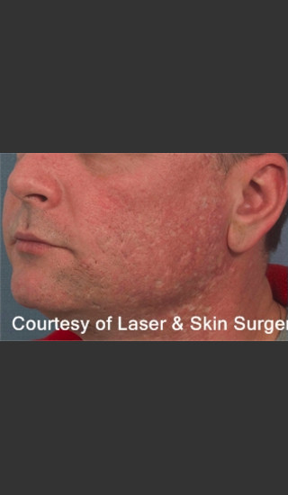 Before Photo for Treatment of Facial  Acne Scars -  - Prejuvenation