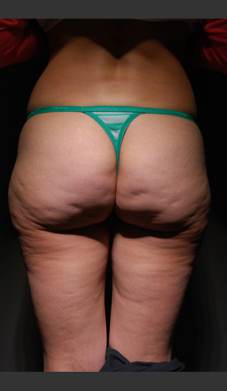 Before Photo for Cellfina Case #2 - South Coast Plastic Surgery - Prejuvenation