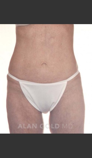 After Photo for Liposuction 380 - Alan Gold MD - Prejuvenation