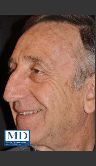 After Photo for Brown Spots on Face Treatment 121 - Jill S. Waibel, MD - Prejuvenation