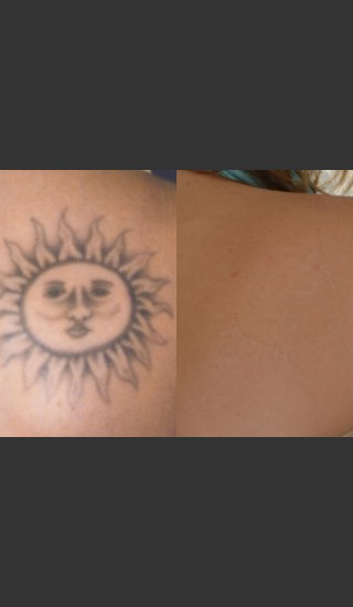 After Photo for Tattoo Removal - Mark B. Taylor, M.D. - Prejuvenation