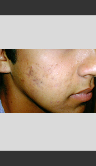 After Photo for elos Technology AC for Acne Treatment -  - Prejuvenation