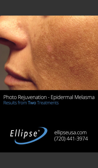 Before Photo for Treatment of Pigmentation and Melasma  -  - Prejuvenation