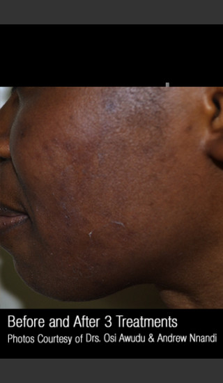 After Photo for Treatment of Active Acne #304 -  - Prejuvenation