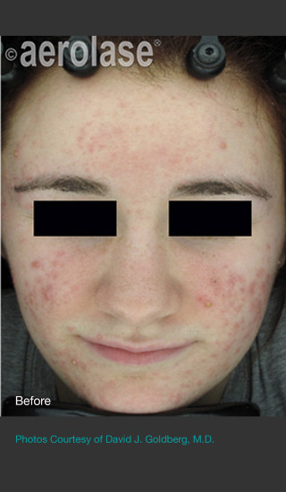 Before Photo for NeoClear by Aerolase Acne Treatment - David J. Goldberg, M.D. - Prejuvenation