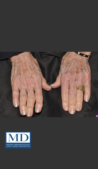 After Photo for Sun Damaged Hands Treatment 115 - Jill S. Waibel, MD - Prejuvenation
