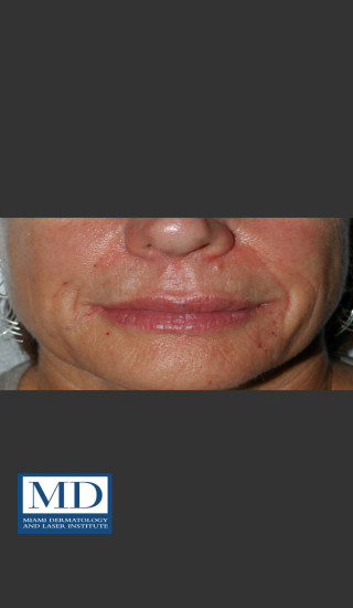 After Photo for Nasolabial Fold and Lip Filler 137 - Jill S. Waibel, MD - Prejuvenation