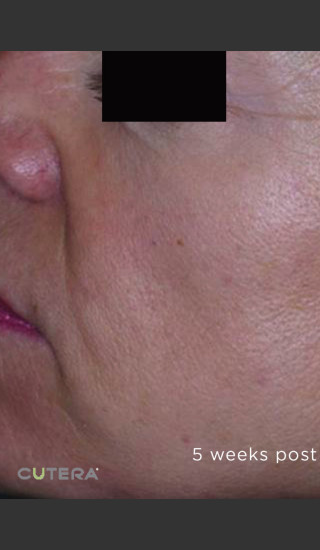 After Photo for Sun Damage Before & After Photo -  - Prejuvenation