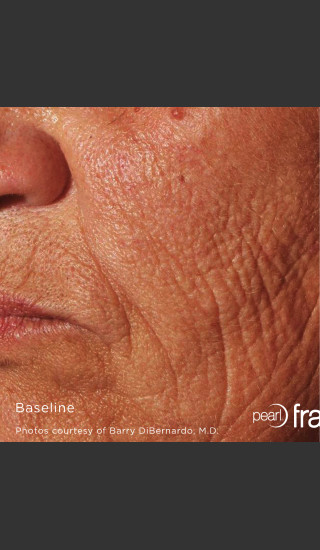 Before Photo for Pearl Fractional Resurfacing of Wrinkles -  - Prejuvenation