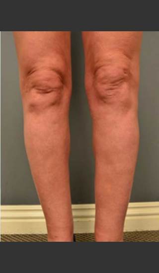 After Photo for Circumferential Liposuction #45 - Dr. David Amron - Prejuvenation