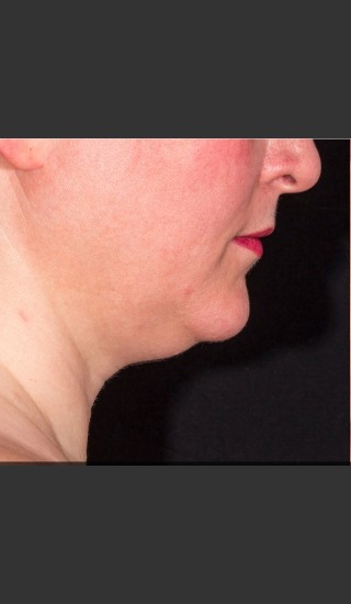 Before Photo for SculpSure Submental - Bruce E Katz, M.D. - Prejuvenation