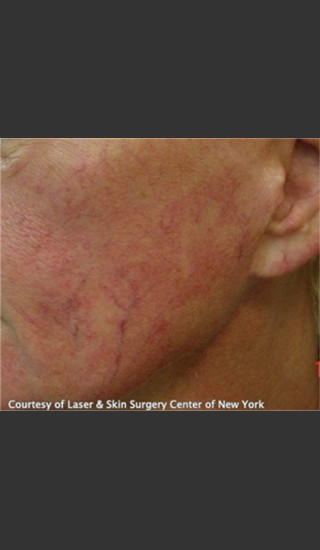 Before Photo for Treatment of Facial Blood Vessels -  - Prejuvenation