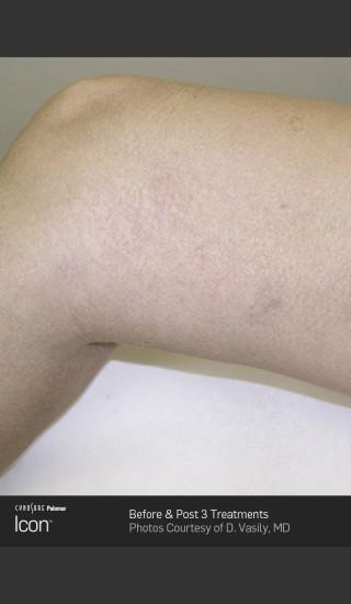 After Photo for Leg Vein Clearance of Upper Thighs Using Icon -  - Prejuvenation