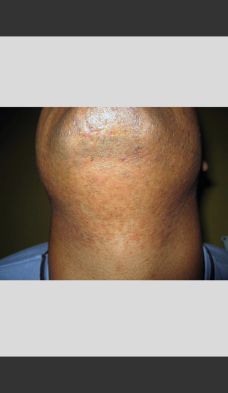 After Photo for Gentle Laser Hair Removal of Beard Bumps -  - Prejuvenation