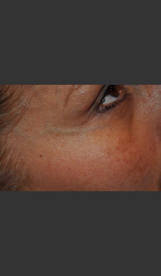 Before Photo for Dr. Palmer Vein Removal 01 - Shane Palmer - Prejuvenation