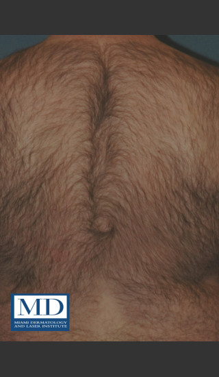 Before Photo for Laser Hair Removal 122 - Jill S. Waibel, MD - Prejuvenation