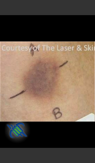 Before Photo for Treatment of Brusing with Pulsed Dye Laser - Roy G. Geronemus, M.D. - Prejuvenation