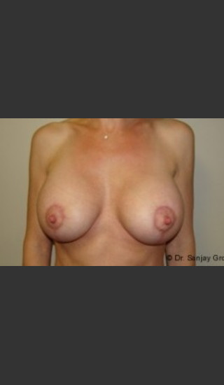 After Photo for Mastopexy 4939 - Sanjay Grover MD FACS - Prejuvenation