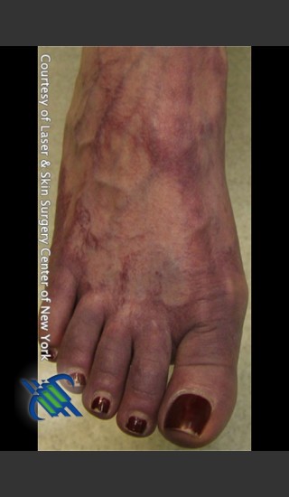 Before Photo for Treatment of Foot Leg Veins - Roy G. Geronemus, M.D. - Prejuvenation