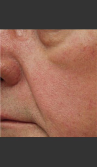 After Photo for Dr. Langdon IPL Treatment  - Robert Langdon - Prejuvenation